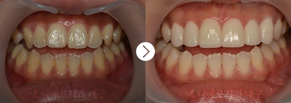 치료사례 윗니 6치아, 치아미백 9회 (3회 내원, 무삭제) : 디에르치과 대구점 전후사진