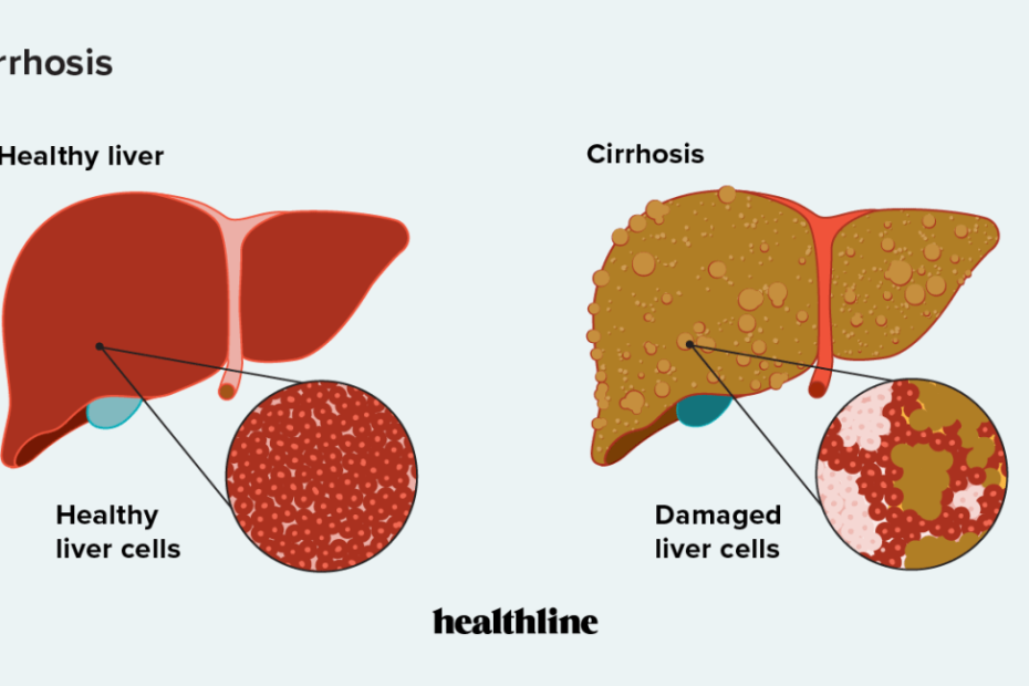 Cirrhosis: Incidence, Symptoms, And Treatment