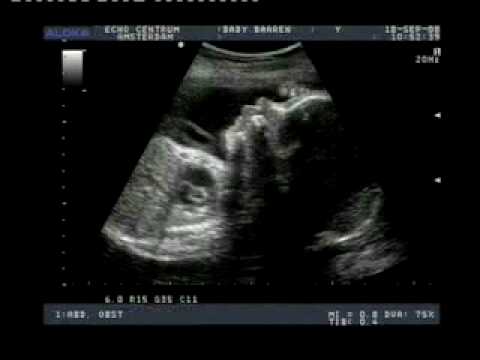 3/4D-baby scans Echo Centrum Amsterdam drs. Elvin Papa